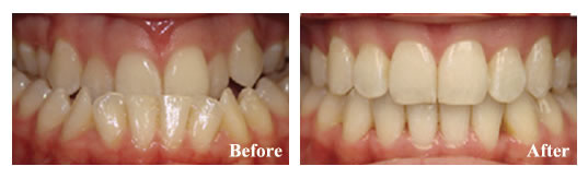 Orthodontics and jaw surgery were required to fix the underbite and crowding in this adult patient.