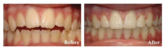 Orthodontics were required to address open bite. We avoided jaw surgery for this patient!