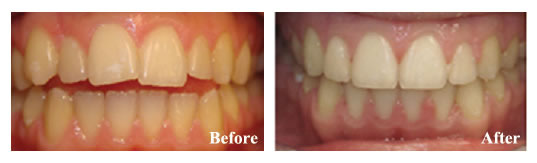Orthodontics were required to fix the open bite and the overjet for this patient. We avoided surgery.