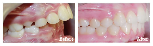 Growth modification and braces eliminated a severe overjet. Jaw surgery was not required for this patient.