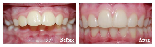 This patient was congenitally missing a lower front tooth. We addressed the significant overjet and the patient did not require a costly implant.