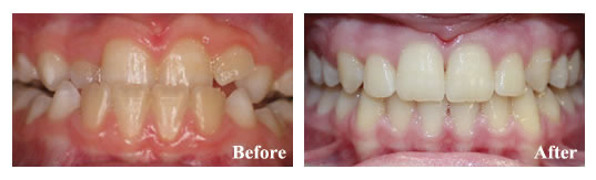 Underbite growth modification and braces for crowding. We avoided a jaw operation!