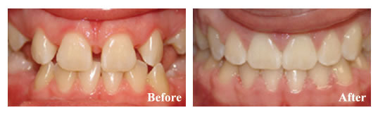 Orthodontics were needed for spacing and impacted upper eye teeth.