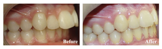 A growth modification removable appliance fixed this patient's bite. We avoided extraction of permanent teeth and jaw surgery!