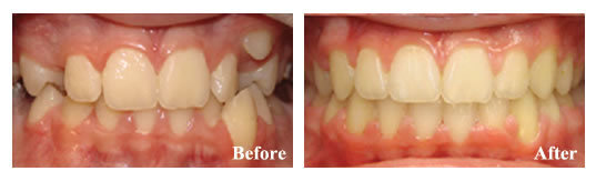 This patient needed orthodontics to address severe crowding. We did not take out any teeth!