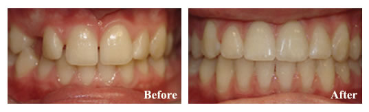 Orthodontics were required to address overbite, spacing, and impacted right eye tooth.