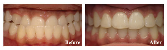 Orthodontics and jaw surgery were required to address the underbite and the crowded and protruded teeth.